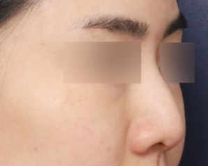 A Review of Reconstructing a Drooping Nose into an Elegant One Through Revision Surgery Near Sinsa Station image 2