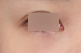 A Review of Medial Epicanthoplasty Revision That Restored a Natural Look to the Inner Corners of the Eyes image 3