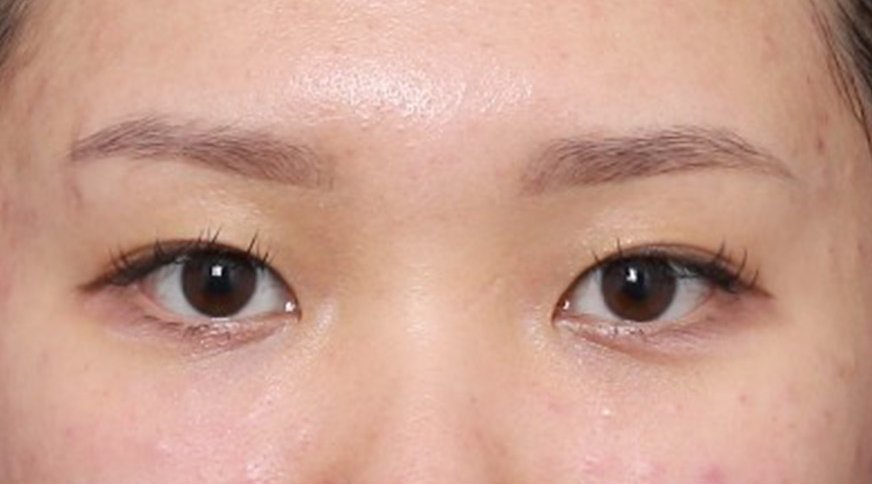 Before and After Eye-Corner Lifting in Sinsa Station for a Sharper Look Through Width Expansion image 2