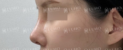 휜코를 교정하여 균형을 되찾은 코재수술 사례 관련 이미지 5