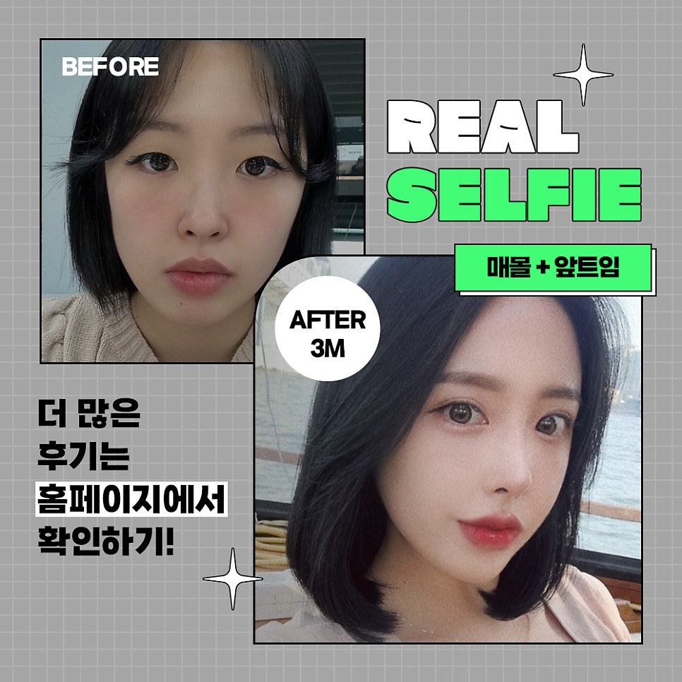［루호성형외과］ 맞춤형 눈성형 관련 이미지 3