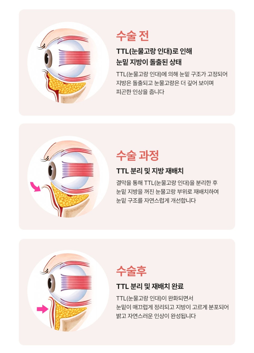 생기 있는 눈매로 환한 인상을 되찾은 신사역 눈밑지 관련 이미지 4