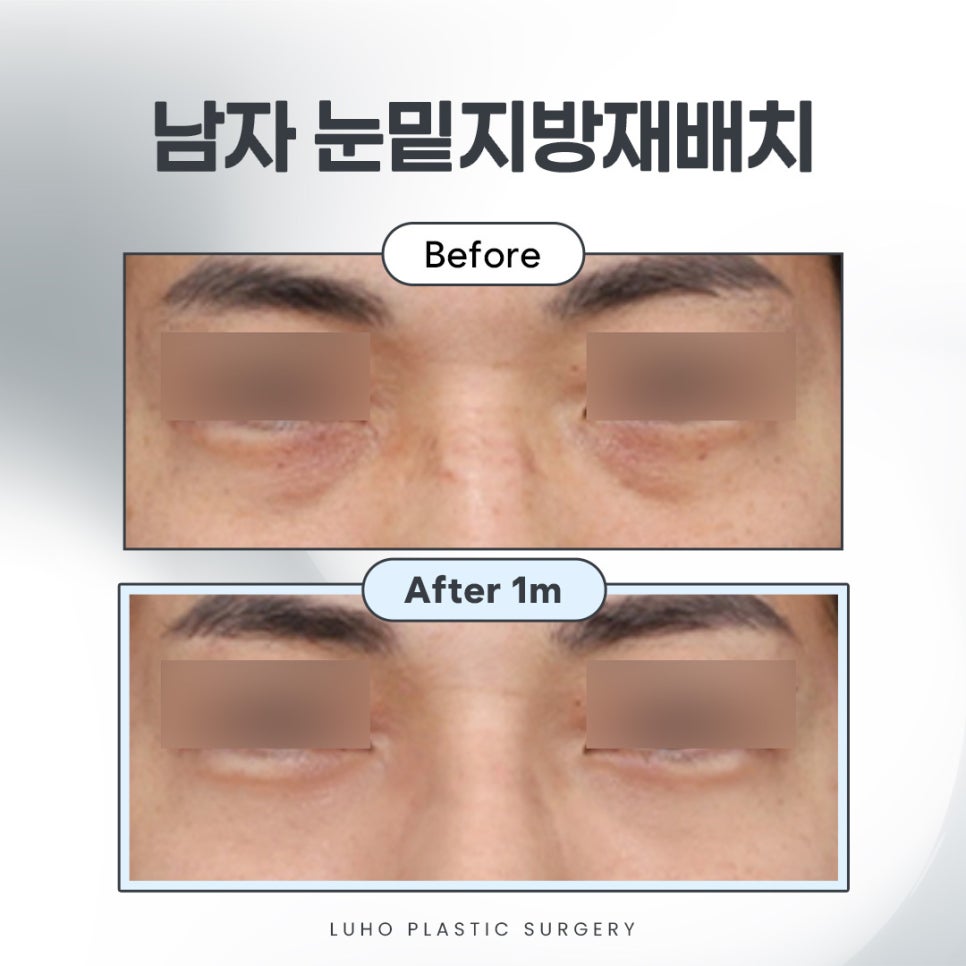 After Men’s Under-Eye Surgery at Sinsa Station That Reduced Dark Circles and Added Vitality image 1