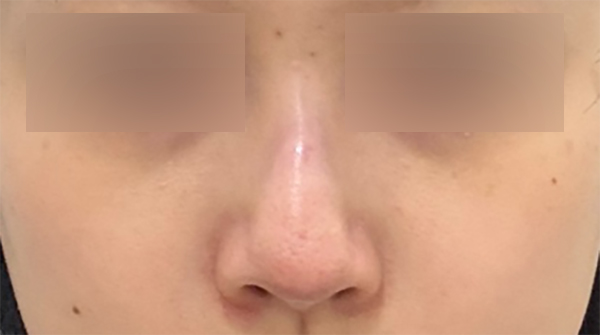 기존 이미지를 유지하면서 라인만 정돈한 코수술 관련 이미지 4
