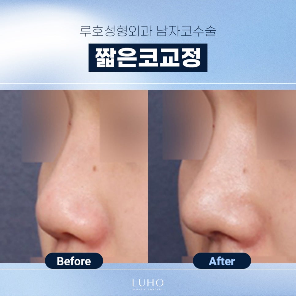 신사역남자코수술, 짧은 코 교정 사례 살펴보기 관련 이미지 1