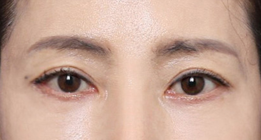 신사역 성형외과, 처진 눈꼬리를 개선한 실제 사례 관련 이미지 3
