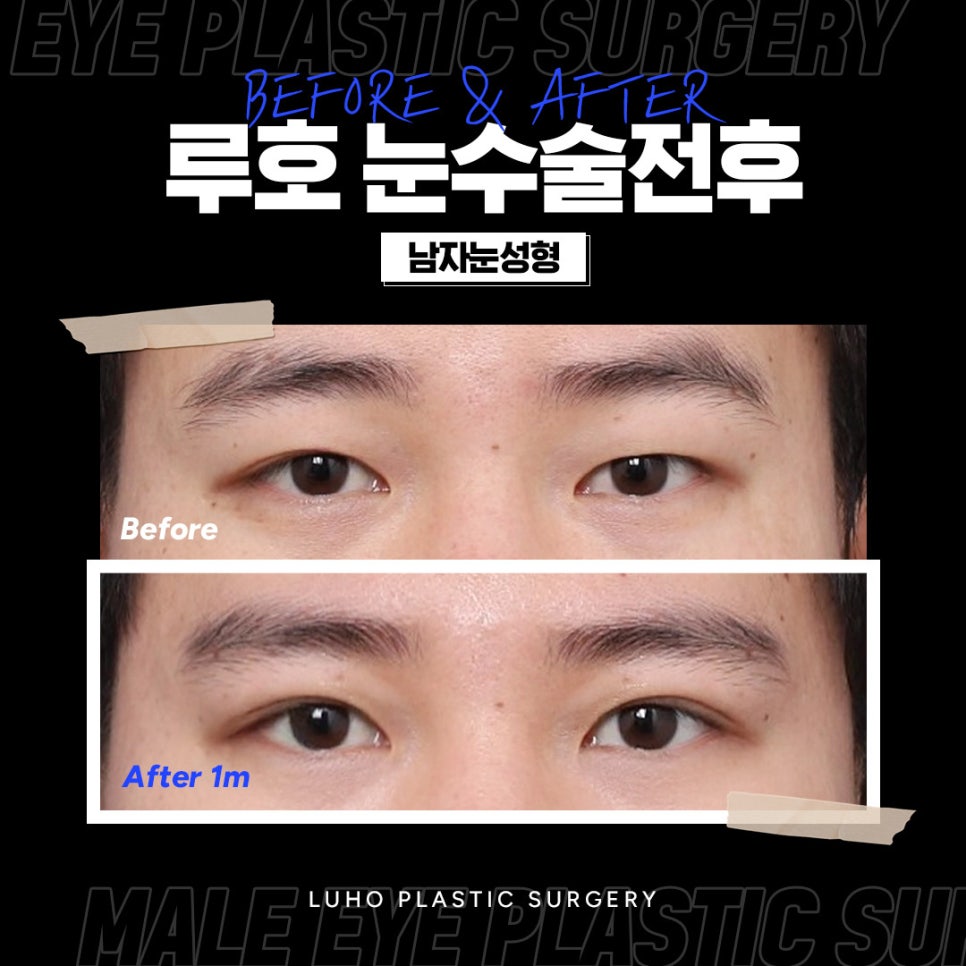 또렷한 눈매로 변한 신사역 남자눈성형 잘하는 곳 후기 관련 이미지 1