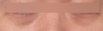 A Plastic Surgery Clinic Near Sinsa Station Specializing in Under-Eye Fat Repositioning: How to Address Under-Eye Areas That Look Like Dark Circles image 3