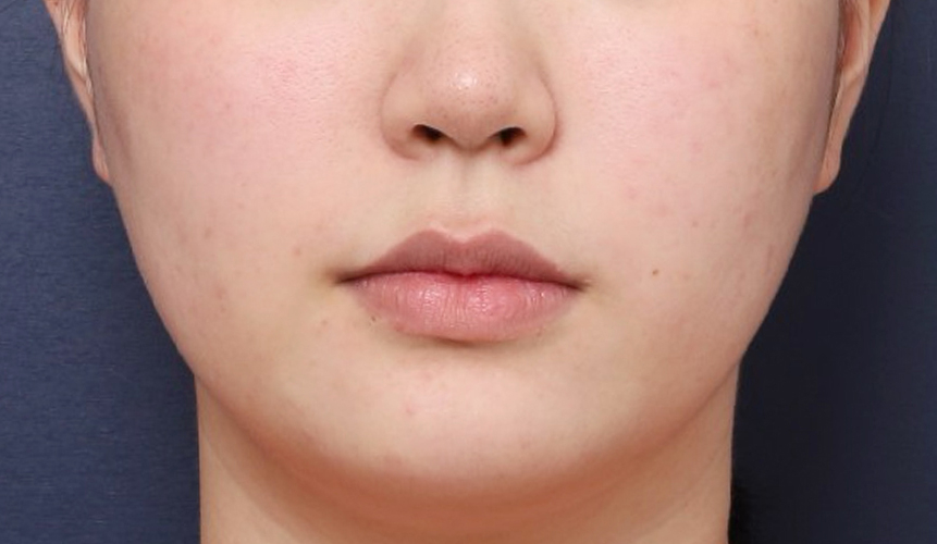 How Chin Contouring Changed with Double Chin Fat Removal image 3