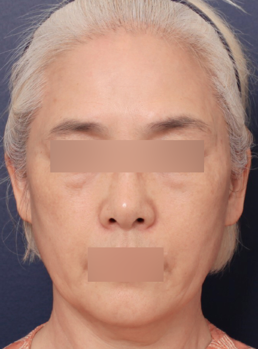 얼굴 전체 흐름이 정리된 신사역 안면거상술 후기 관련 이미지 2