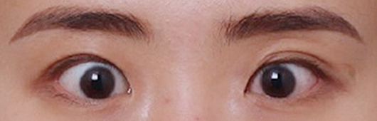 과교정된 쌍꺼풀 라인, 신사역 눈재수술 받은 개선 케이스 관련 이미지 2