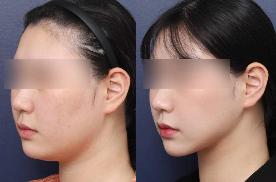 무너진 턱 선을 살려주는 이중턱수술, 핵심은? 관련 이미지 4