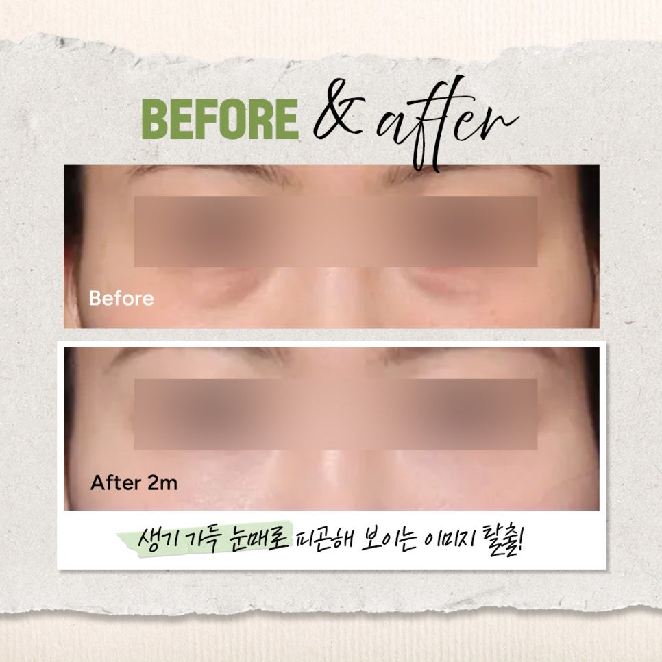 눈 밑 꺼짐을 개선하고 환하게 변한 신사역 눈밑지 전후 비교 관련 이미지 4