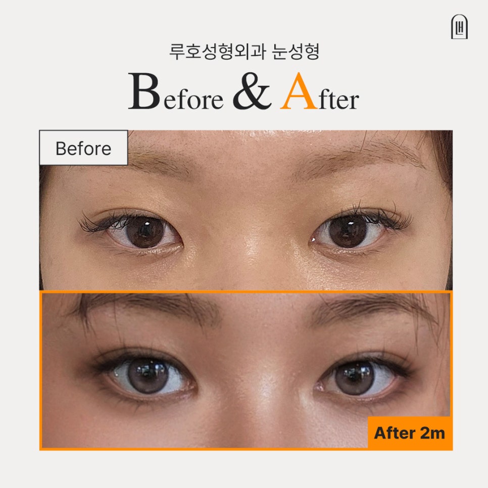 신사역 눈성형으로 완성한 또렷한 눈매, 눈꼬리까지 달라진 변화 관련 이미지 1