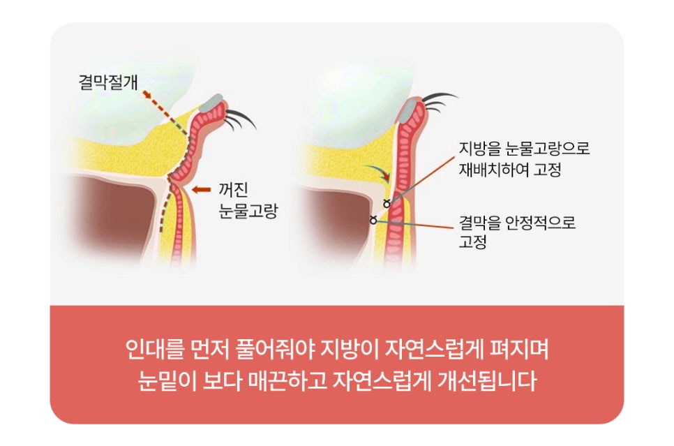A Review of Under-Eye Surgery Near Sinsa Station That Changed My Shadowed Impression Caused by Dark Circles image 4
