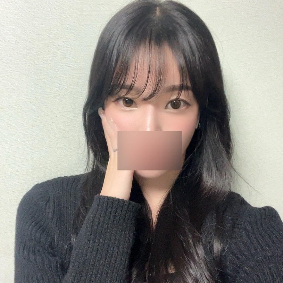 A Review of Shinsegae Station Under-Eye Fat Repositioning to Improve Dark Shadows Under the Eyes image 4