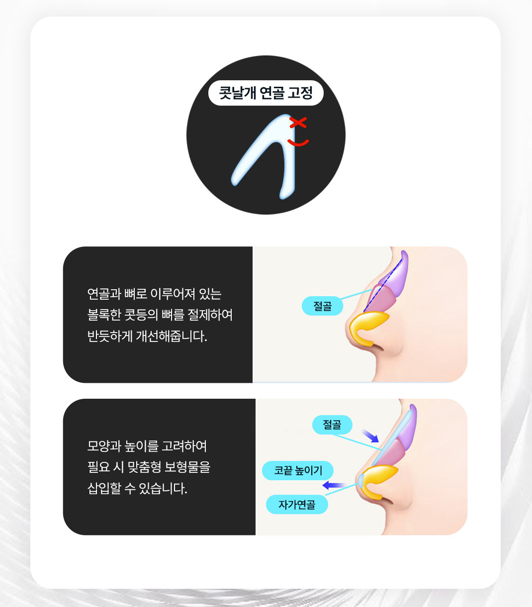 A Shinsegae Station Nose Surgery Review That Sharpened the Center of the Face with Tip Reduction image 4