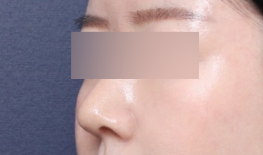 Rhinoplasty for a Hump Nose at Sinsa Station: A Review of the Change to a Smooth Line image 4