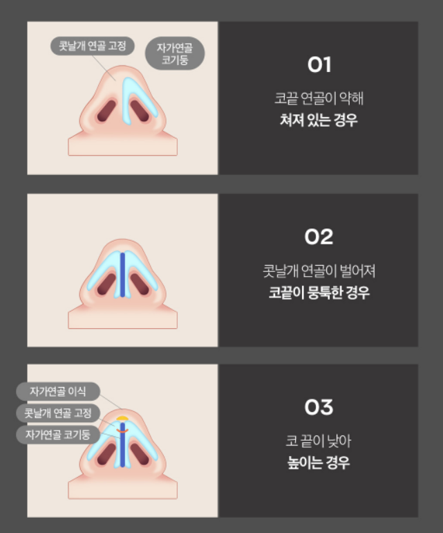 [Luho Plastic Surgery] Luho’s First Nose Surgery image 5
