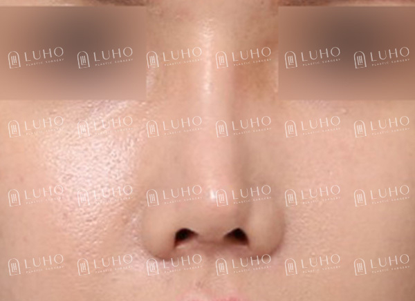 휜코를 교정하여 균형을 되찾은 코재수술 사례 관련 이미지 2
