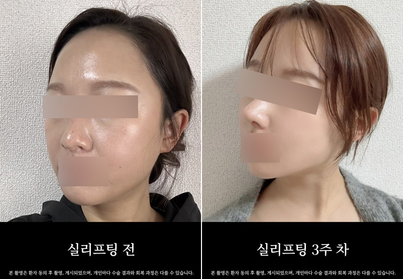 논현역 실리프팅, 나에게 어떤 종류가 맞을지 관련 이미지 4