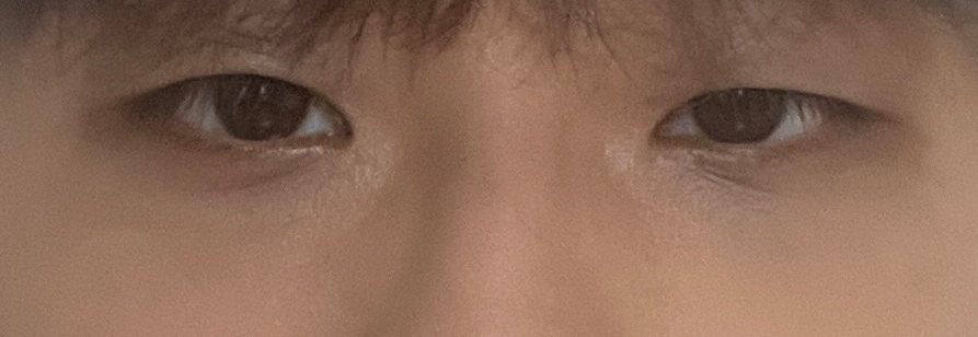 Review of Double Eyelid Surgery for Uneven Eyes at Sinsa Station for Men image 2