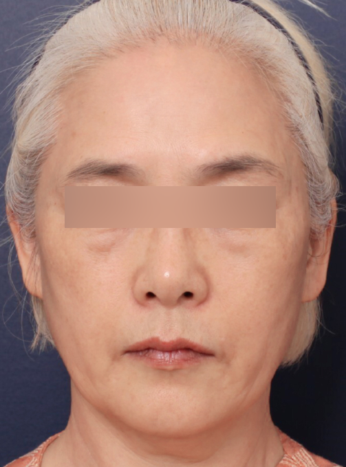 A Case of Facelift Surgery at Sinsa Station That Restored Weakened Midface Support image 3