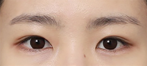 신사역 졸린 눈 눈매교정 전후 살펴보기 관련 이미지 3