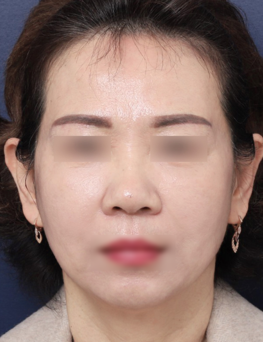 [Sinsa Station Facelift Plastic Surgery Clinic] Looking at a Case of Improved Jowl Sagging image 4
