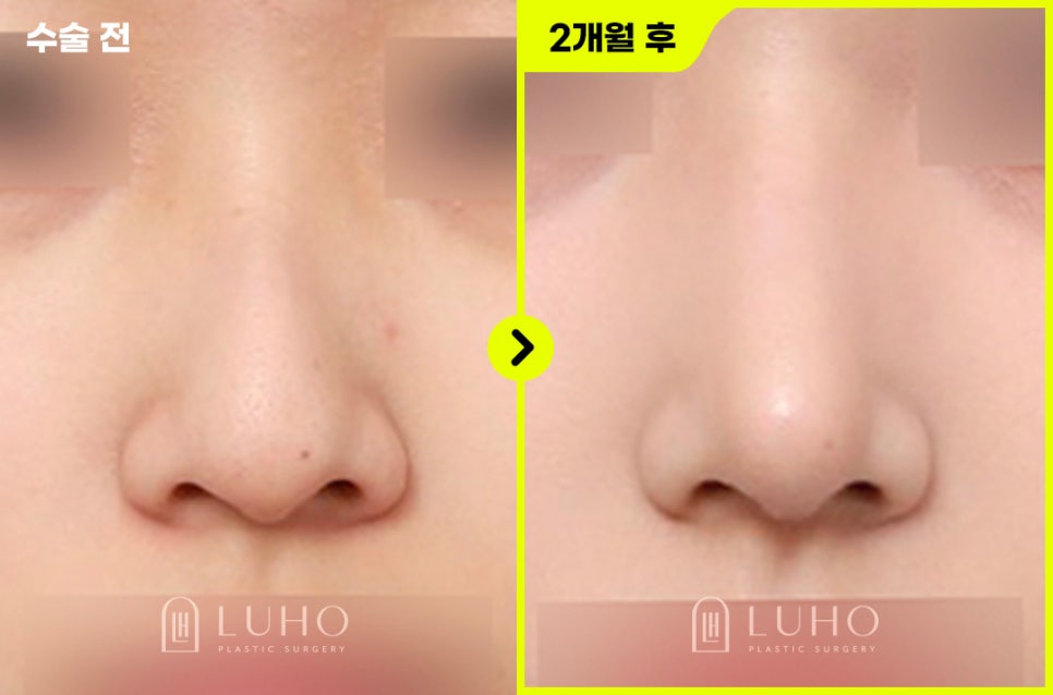 Non-Implant Rhinoplasty at Luho Plastic Surgery near Sinsa Station image 1