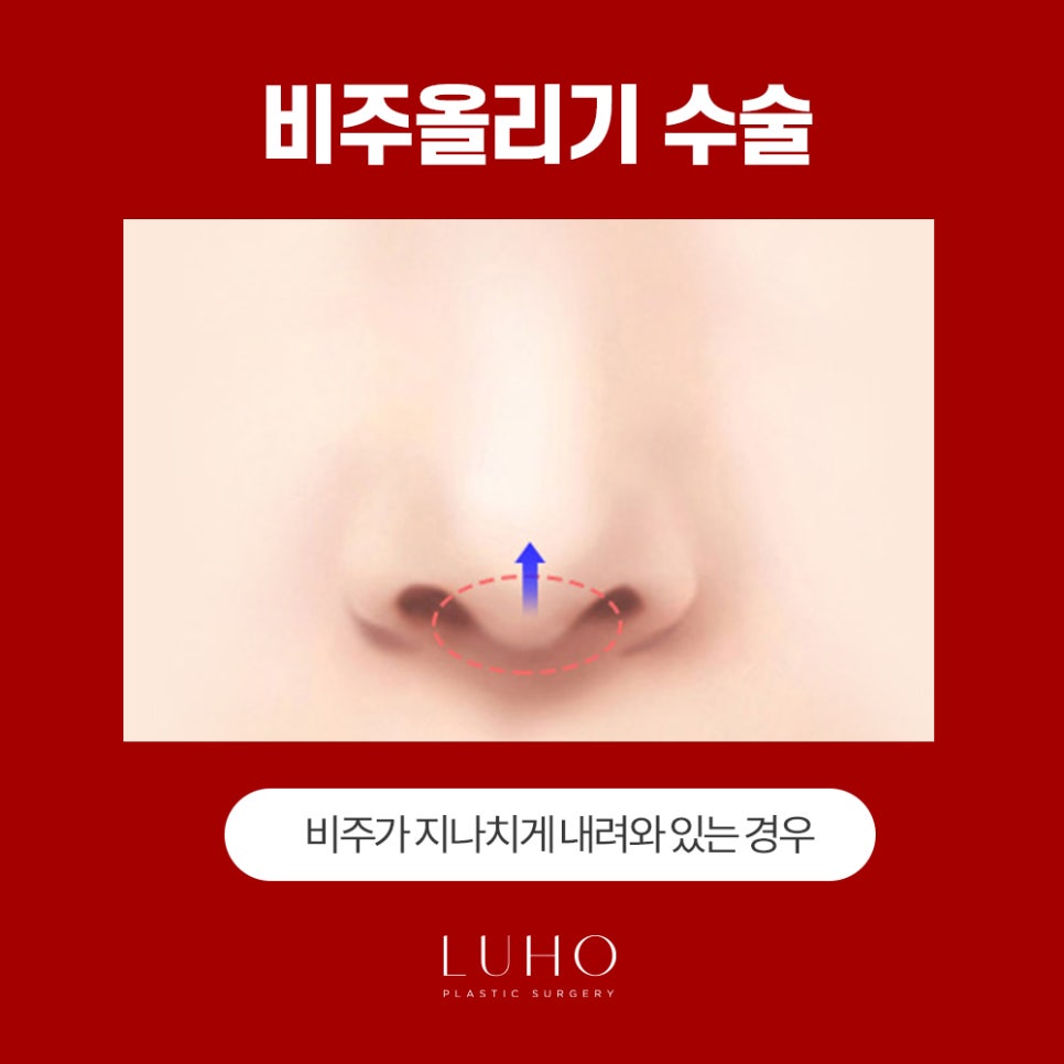 콧날개는 Down! 외모는 Up! 관련 이미지 9