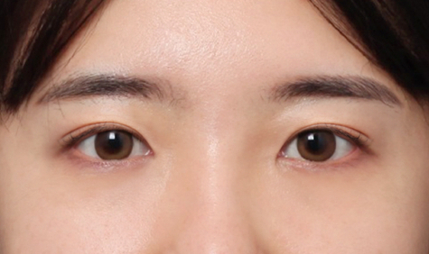 A Case of Forehead Lift Surgery in Sinsa Station That Improved Both a Drooping Forehead and Eyebrows image 5