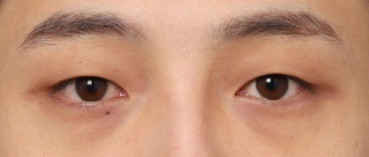 자연스러운 눈매 변화가 돋보이는 남자눈성형 후기 관련 이미지 3