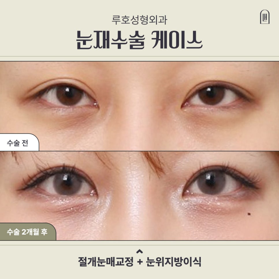 신사역 눈재수술, 절개눈매교정과 눈위지방이식으로 또렷해진 눈매 관련 이미지 1