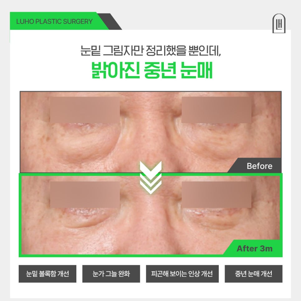 무거운 눈밑을 가볍게 바꿔준 하안검수술 효과 살펴보기 관련 이미지 1