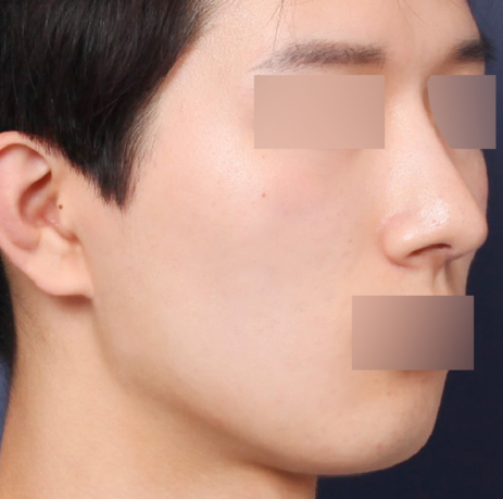 A Review of a Sinsa Station Clinic Known for Male Rhinoplasty That Created a Refined Image image 5