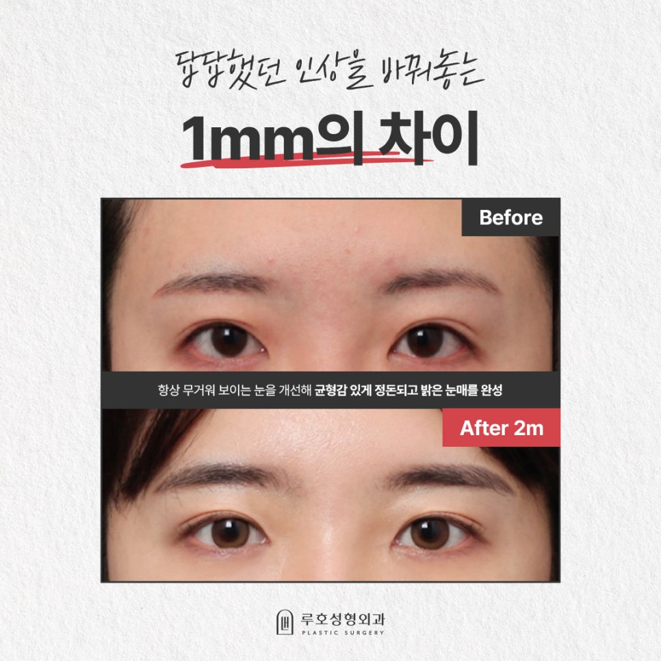 A Case of Forehead Lift Surgery That Gave a Heavy Appearance More Definition image 1