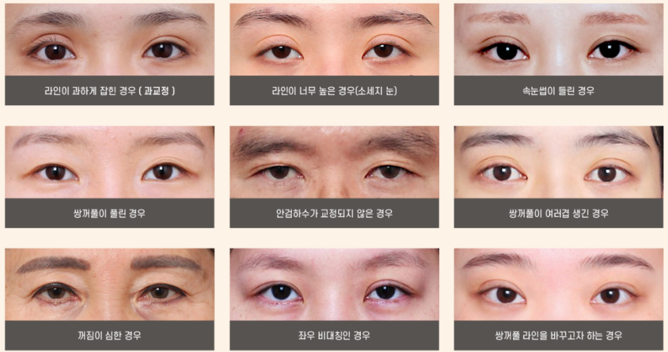 신사역 소시지 눈 재수술 성형외과 쌍꺼풀 전후 후기 관련 이미지 4