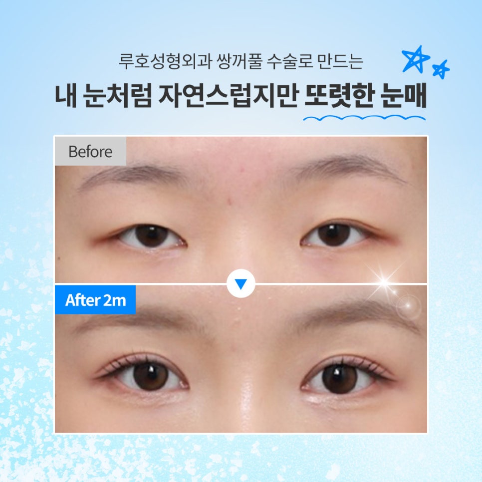 수술 후기로 파악하는 쌍꺼풀 잘하는 병원 기준 관련 이미지 1