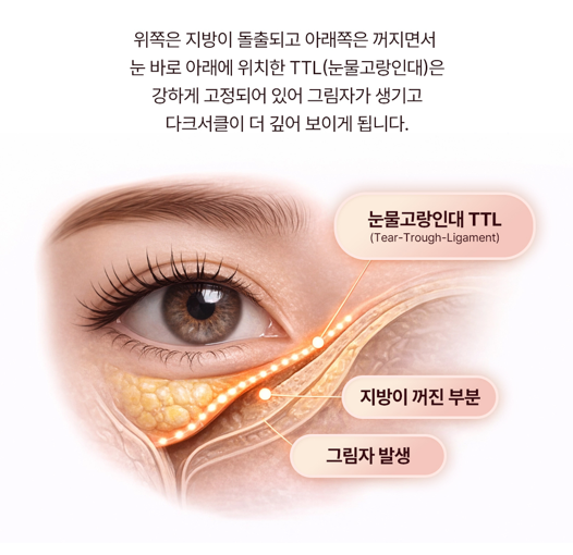 신사역 다크서클 고민, 루호성형외과에서 밝아진 눈매 후기 관련 이미지 3