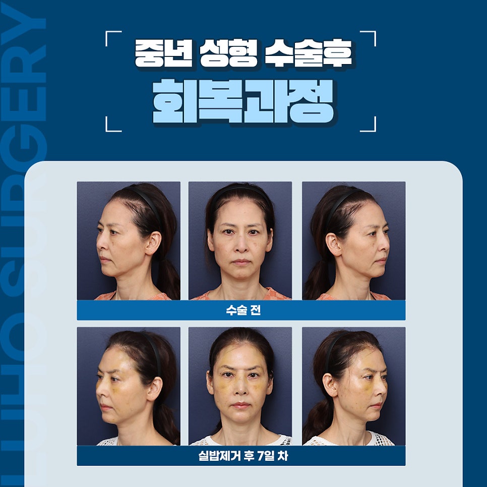 Luho Plastic Surgery Middle-Age Cosmetic Surgery Recovery Real Review: How Much Will It Change After 1 Month? image 2