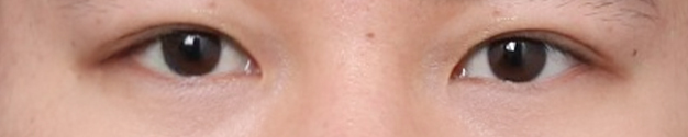 A Place Near Sinsa Station Known for Eye Surgery, Key Points for Improving the Eye Shape image 5
