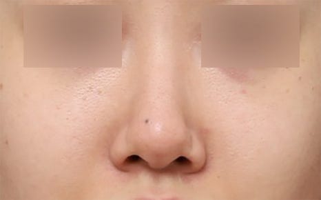 직반라인으로 디자인해 또렷한 존재감을 더한 코수술 효과 관련 이미지 3