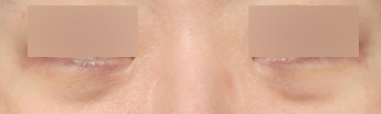 Sinsa Station Under-Eye Fat Repositioning Clinic: Dark Circles + Review of Improvement for Uneven Under-Eyes image 2
