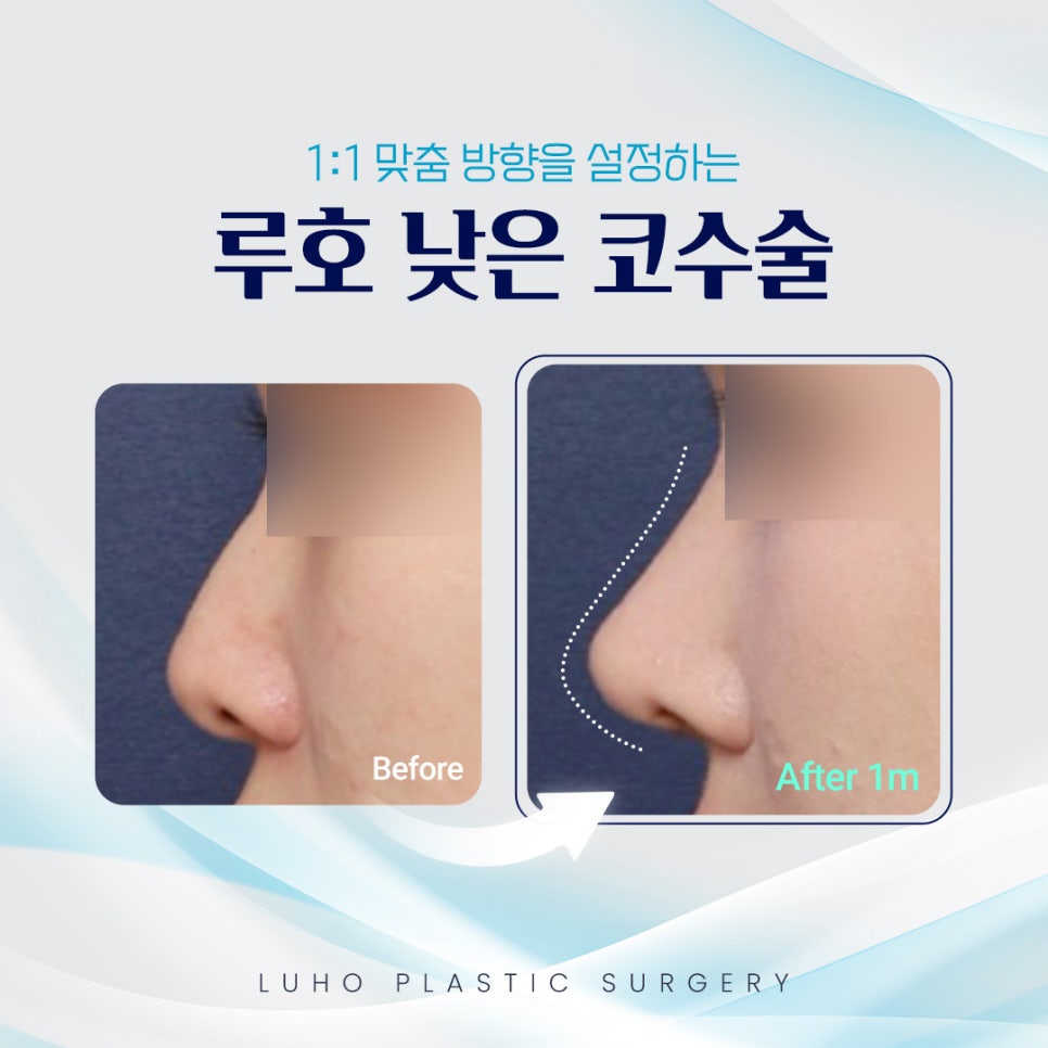 밋밋한 인상을 자려한 코로 바꿔놓은 신사역 낮은코수술 사례 관련 이미지 6