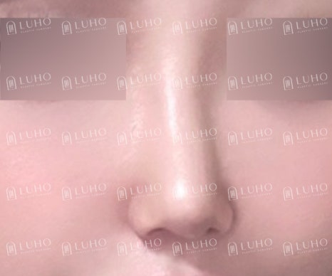 직반라인으로 디자인해 또렷한 존재감을 더한 코수술 효과 관련 이미지 8