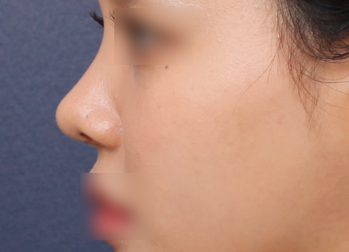 How to Address a Button Nose Based on a Surgery Review from Sinsa Station image 6