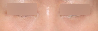 A Review of Lower Eyelid Fat Repositioning at Sinsa Station That Helped Soften Noticeable Dark Circles image 5