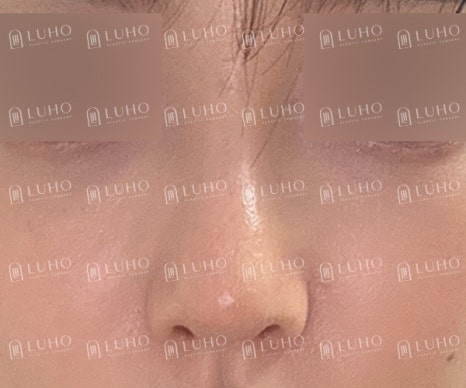 기존 이미지를 유지하면서 라인만 정돈한 코수술 관련 이미지 9
