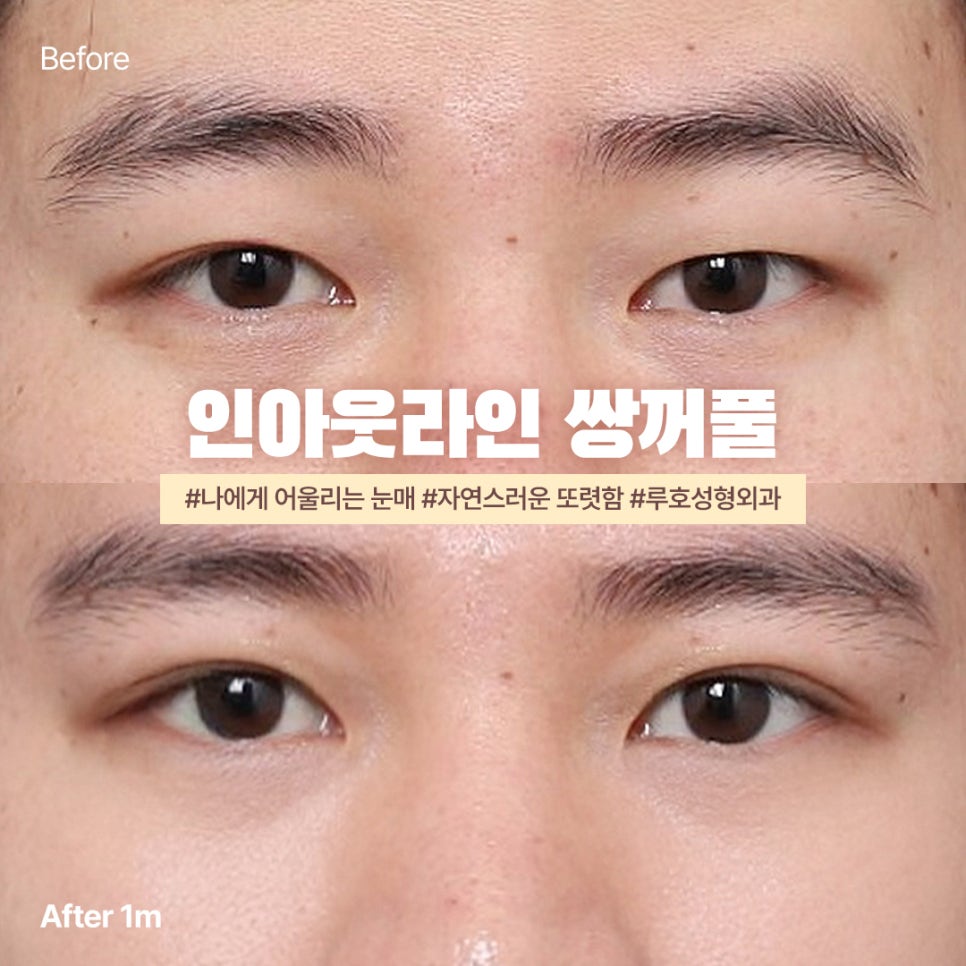 인아웃라인 쌍꺼풀, 나에게도 어울리게 만들려면 관련 이미지 1